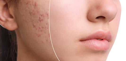 Kompletter K-Beauty-Leitfaden: Wie man mit unreiner Haut und Narben umgeht + Top-Inhaltsstoffe und Produkte-Wonder Skin