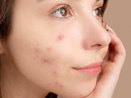 Hautbarriere wiederherstellen: Deine Routine für zuhause-Wonder Skin