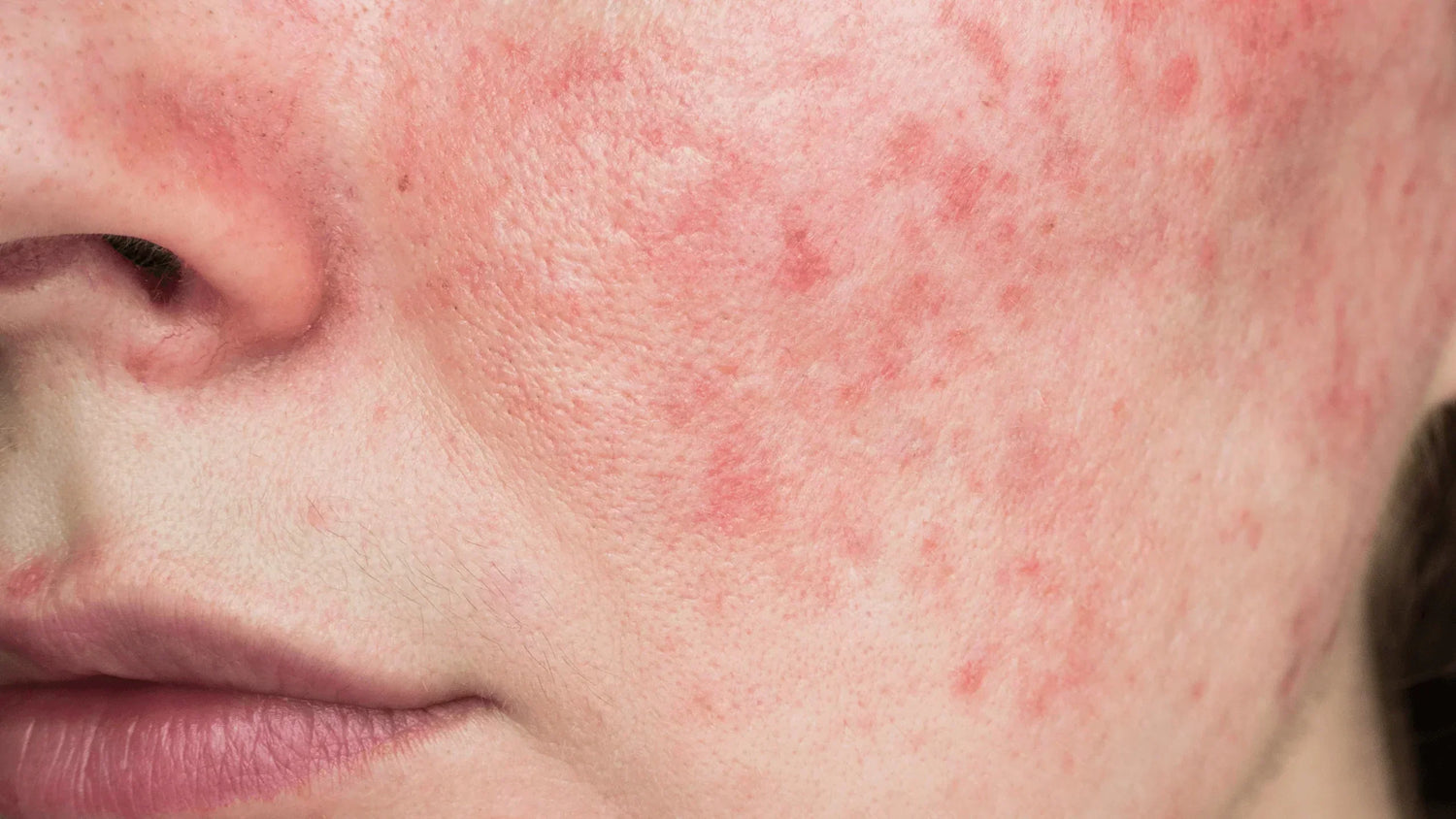 Geschädigte Hautbarriere: Anzeichen, Ursachen und die besten K-Beauty Tipps zur Regeneration-Wonder Skin