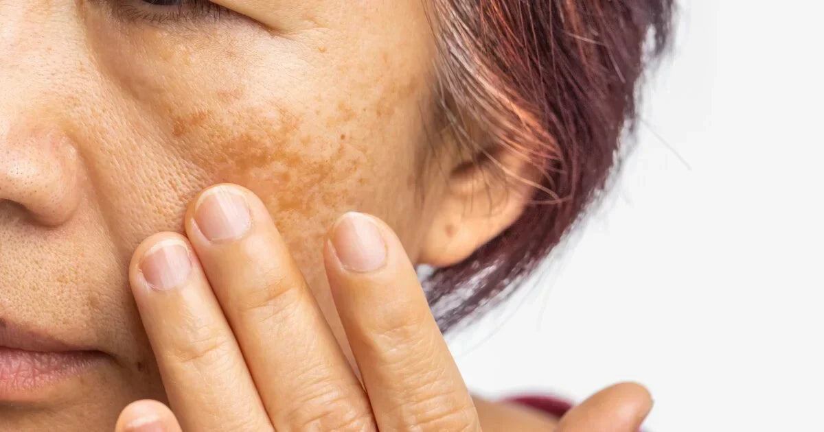 Pigmentflecken ab 40, TXA Serum, Azelainsäure Haut