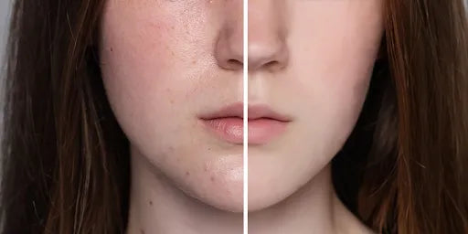 Trockene vs. dehydrierte Haut - Wonder SKin