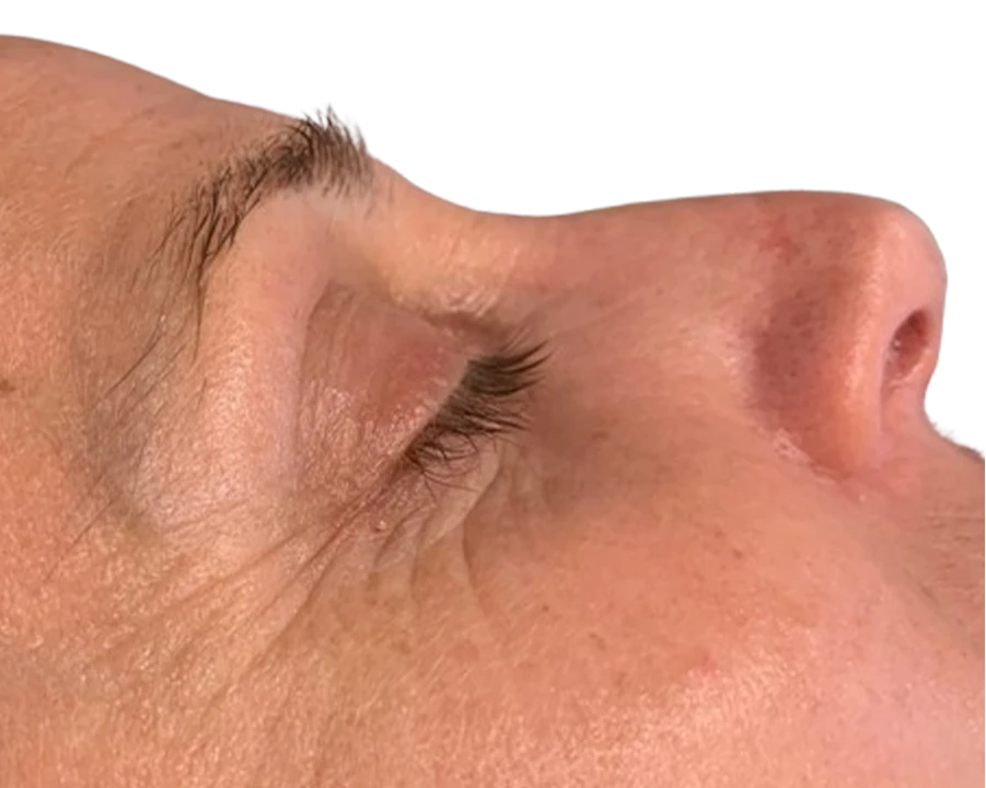 before_after_fine-lines_wrinkles_2_after-Wonder Skin