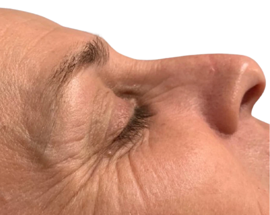 before_after_fine-lines_wrinkles_2_before-Wonder Skin